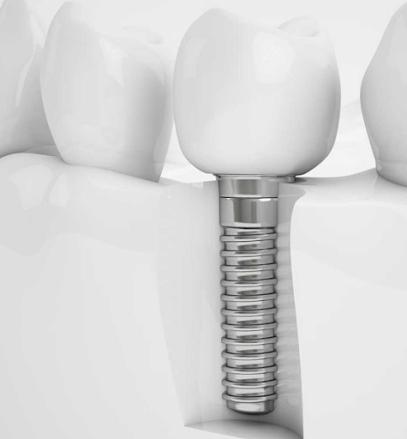 Bloomington Periodontics & Dental Implants – Dr. Mark Sutor & Dr. Brett Kelly - General dentist in Bloomington, IN