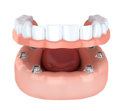 Placentia Oral Surgery - Oral surgeon in Placentia, CA