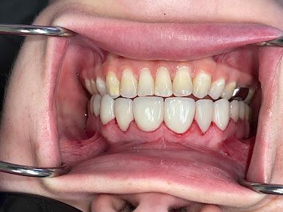 Veneers and Lumineers - General dentist in Cambridge, MA