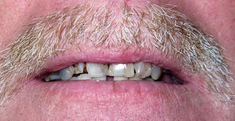 Mini Dental Implant Center - General dentist in Sebring, FL