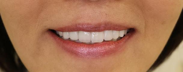 Simply Veneers - Cosmetic dentist, General dentist in Newport Beach, CA