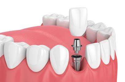 Sunrise Dental Sequim - General dentist in Sequim, WA